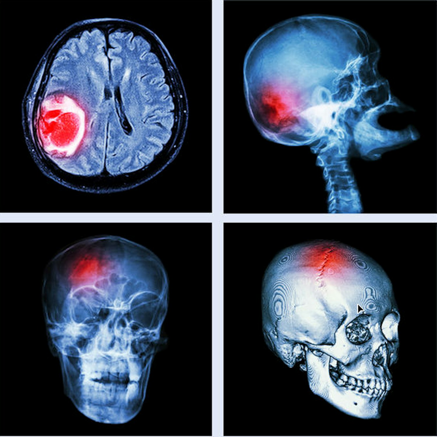 Травма в мозгу повреждения. Перелом основания черепа ОЧМТ или ЧМТ. Черепно-мозговая травма рентген. Перелом черепа головного мозга. Открытый перелом основания черепа.